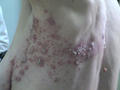 VIRAL INFECTIONS - Herpes Zoster
