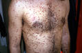 MASTOCYTOSES - Urticaria Pigmentosa