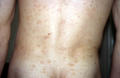 VARIOUS or of UNKNOWN ETIOLOGY DISEASES - Pityriasis rosea