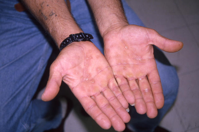 SYPHILIS AND OTHER SEXUAL TRANSMITTED DISEASES - Secondary syphilis SYPHILIS AND OTHER SEXUAL TRANSMITTED DISEASES - Secondary syphilis