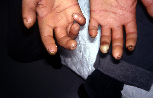 CONNECTIVE TISSUE DISORDERS - Scleroderma CONNECTIVE TISSUE DISORDERS - Scleroderma