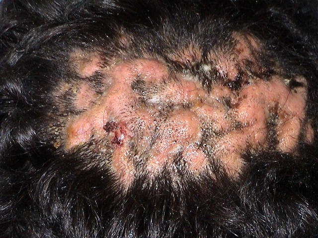 Folliculitis - Pictures, Symptoms, Causes, Types, Treatment