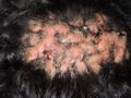 BACTERIAL INFECTIONS - Deep folliculitis