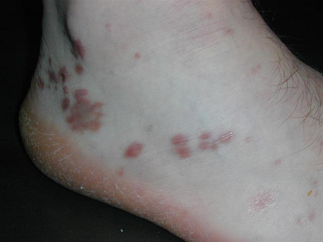 LICHEN - Lichen planus, annular LICHEN - Lichen planus, annular