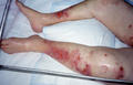 BULLOUS DISEASES - Bullous pemphigoid