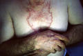 NECROBIOTIC DISORDERS - Granuloma Annulare