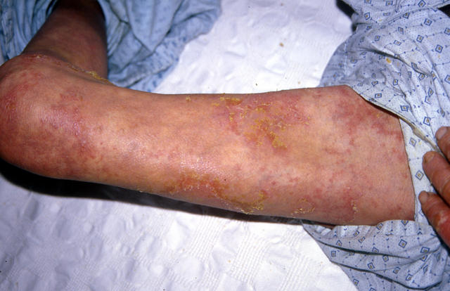 PSORIASIS - Pustular psoriasis