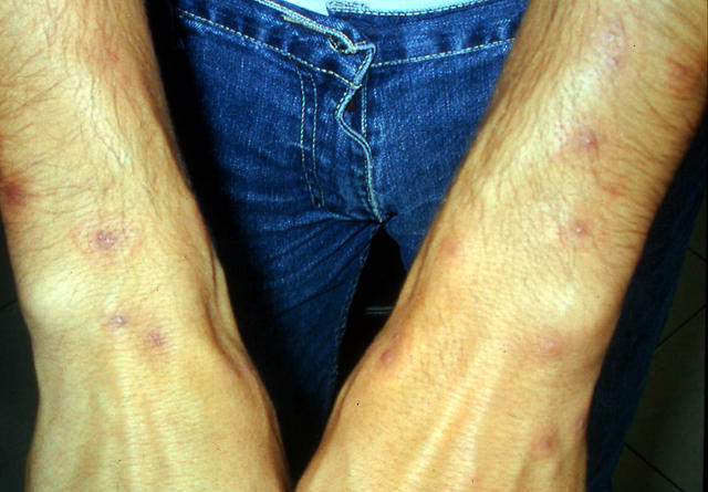 PARASITOSES, BITES - Insect bites PARASITOSES, BITES - Insect bites