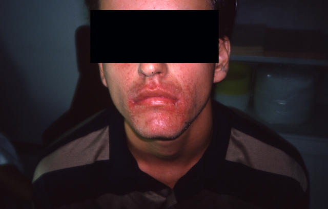 DERMATITIS - EKZEMA - Perioral dermatitis