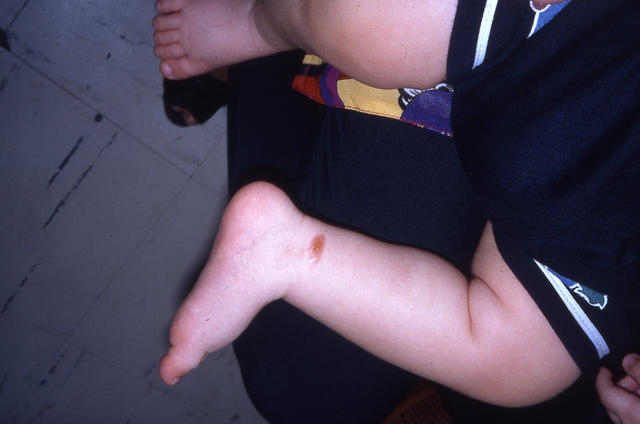 MASTOCYTOSES - Mastocytoma MASTOCYTOSES - Mastocytoma