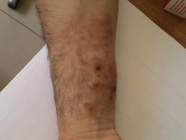 SUPERFICIAL FUNGAL INFECTIONS - Tinea Incognita SUPERFICIAL FUNGAL INFECTIONS - Tinea Incognita