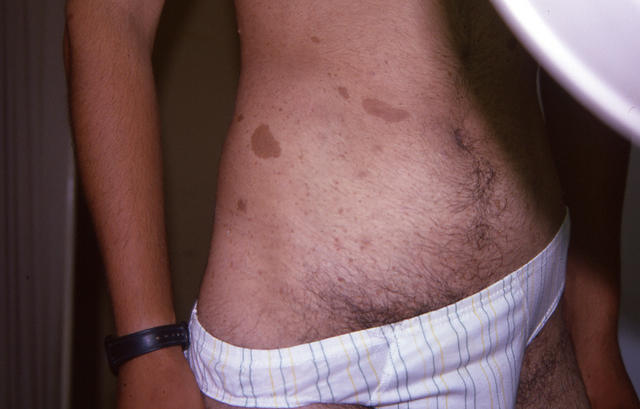 GENODERMATOSES - Neurofibromatosis (νon Recklinghausen's disease)