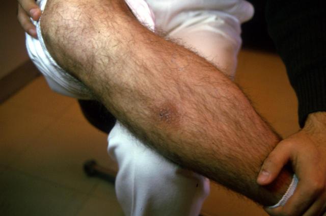 DRUG ERUPTIONS - Fixed drug eruption DRUG ERUPTIONS - Fixed drug eruption