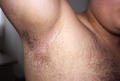 KERATINISATION DISORDERS - Acanthosis nigricans