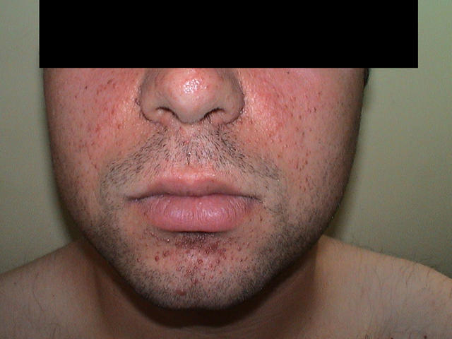 GENODERMATOSES - Tuberous sclerosis complex (Bourneville's disease), adenomata seborrheic