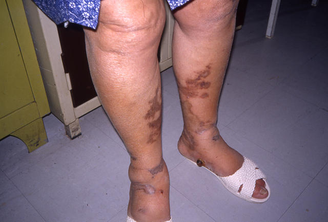 SOFT TISSUE TUMORS - Kaposi sarcoma SOFT TISSUE TUMORS - Kaposi sarcoma