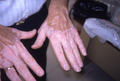 PIGMENTATION DISORDERS - Vitiligo and Lichen planus