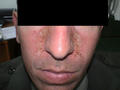 DERMATITIS - EKZEMA - Seborrheic Dermatitis