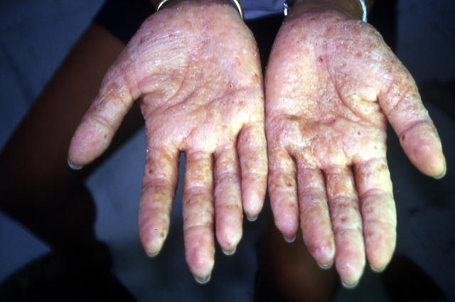DERMATITIS - EKZEMA - Hand eczema DERMATITIS - EKZEMA - Hand eczema