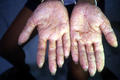 DERMATITIS - EKZEMA - Hand eczema