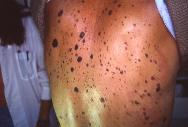 BENIGN SKIN LESIONS, NEVI, CYSTS - Seborrheic keratosis