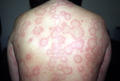 URTICARIA - Urticaria