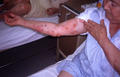 BULLOUS DISEASES - Bullous pemphigoid