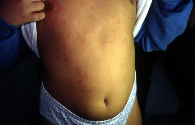 URTICARIA - Urticaria URTICARIA - Urticaria