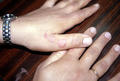 NECROBIOTIC DISORDERS - Granuloma Annulare