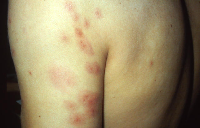 PARASITOSES, BITES - Insect bites PARASITOSES, BITES - Insect bites
