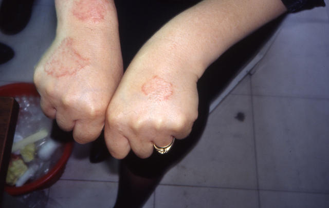 DERMATITIS - EKZEMA - Nummular eczema