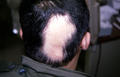 HAIR DISEASES - Alopecia Areata