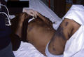 SKIN LESIONS IN HIV-AIDS PATIENTS - Pigmentation in a patient wit AIDS