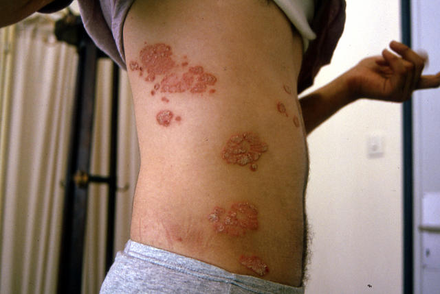 PSORIASIS - Plaque psoriasis