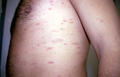 VARIOUS or of UNKNOWN ETIOLOGY DISEASES - Pityriasis rosea