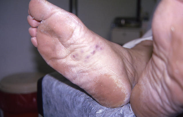 SOFT TISSUE TUMORS - Kaposi sarcoma SOFT TISSUE TUMORS - Kaposi sarcoma