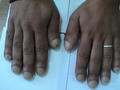 NAIL DISEASES - Clubbing