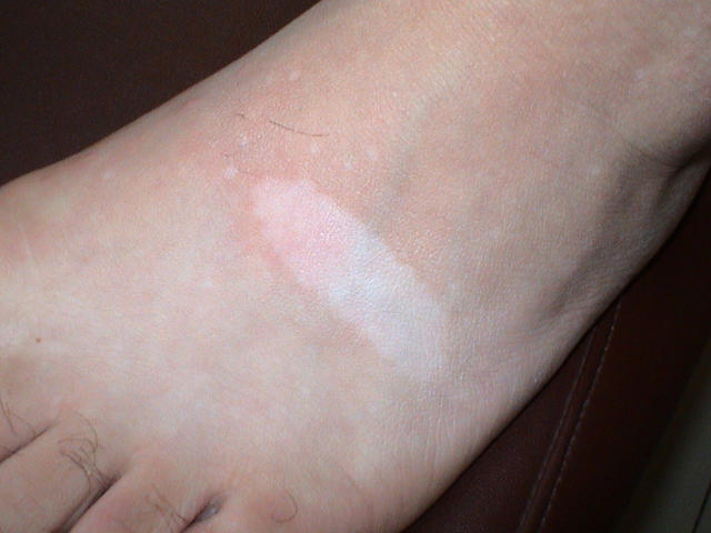 GENODERMATOSES - Tuberous sclerosis complex GENODERMATOSES - Tuberous sclerosis complex