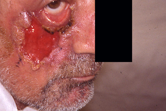 DISEASE OF THE BLOOD AND THE VESSELS – PURPURAS - Pyoderma Gangrenosum