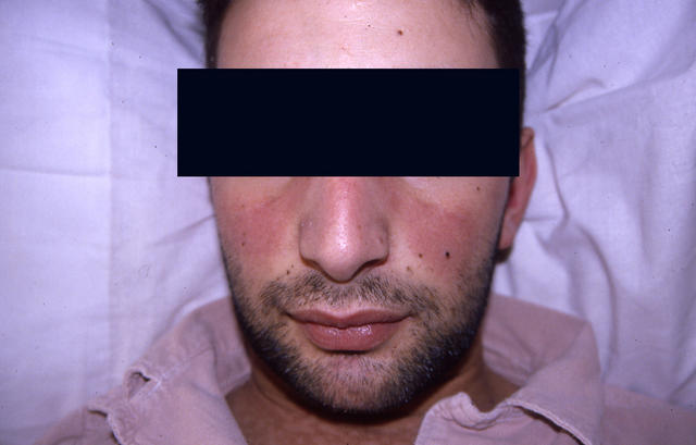 CONNECTIVE TISSUE DISORDERS - Systemc lupus erythematosus CONNECTIVE TISSUE DISORDERS - Systemc lupus erythematosus