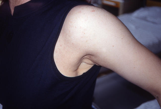 METABOLIC DISEASE, NUTRITION - Pseudoxanthoma elasticum METABOLIC DISEASE, NUTRITION - Pseudoxanthoma elasticum