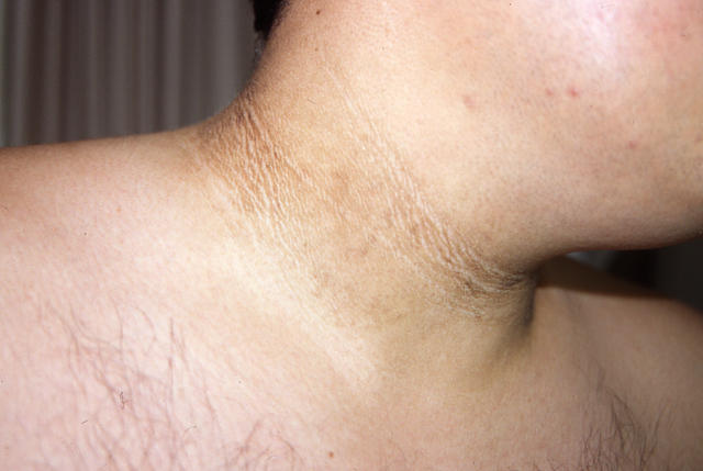 KERATINISATION DISORDERS - Acanthosis nigricans