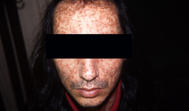 MASTOCYTOSES - Urticaria Pigmentosa MASTOCYTOSES - Urticaria Pigmentosa
