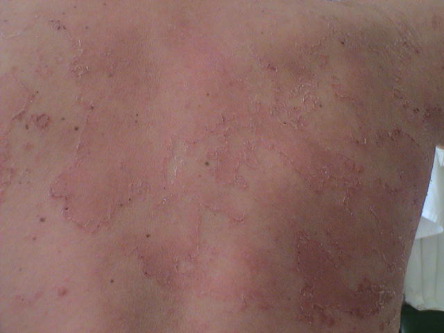 GENODERMATOSES - Netherton syndrome GENODERMATOSES - Netherton syndrome