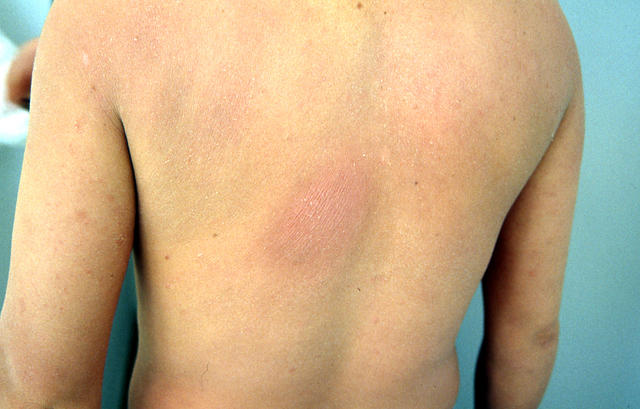 VARIOUS or of UNKNOWN ETIOLOGY DISEASES - Plaque parapsoriasis VARIOUS or of UNKNOWN ETIOLOGY DISEASES - Plaque parapsoriasis