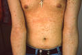 SUPERFICIAL FUNGAL INFECTIONS - Pityriasis versicolor