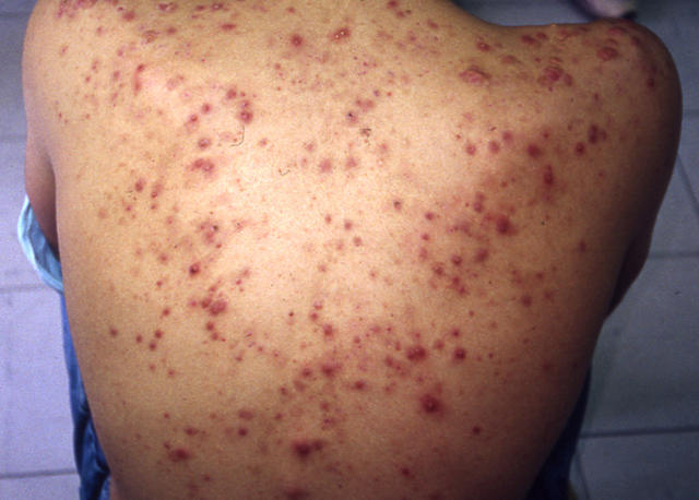 DISEASES OF THE SEBACEOUS GLANDS - Acne, inflammatory