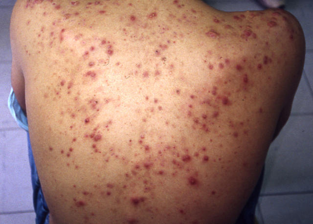 DISEASES OF THE SEBACEOUS GLANDS - Acne, inflammatory DISEASES OF THE SEBACEOUS GLANDS - Acne, inflammatory
