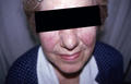 DISEASES OF THE SEBACEOUS GLANDS - Rosacea