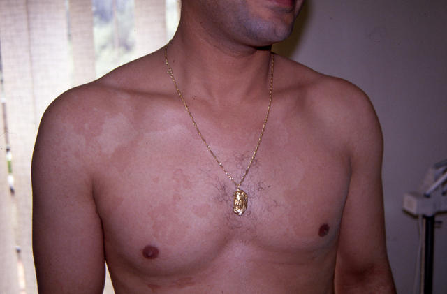 SUPERFICIAL FUNGAL INFECTIONS - Pityriasis versicolor